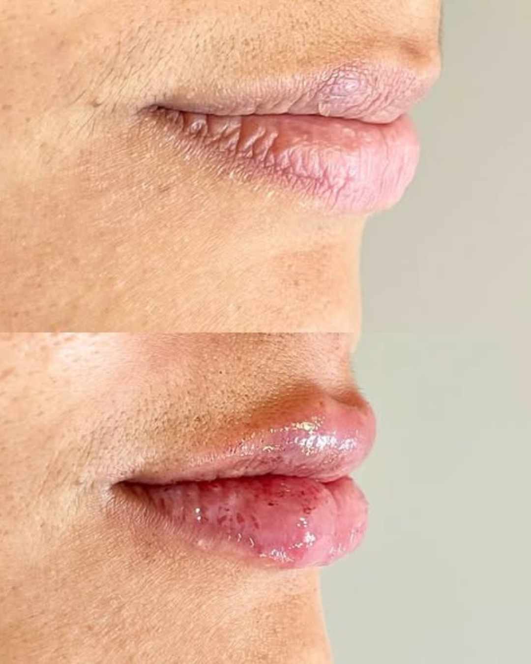 Resultado — Preenchimento labial